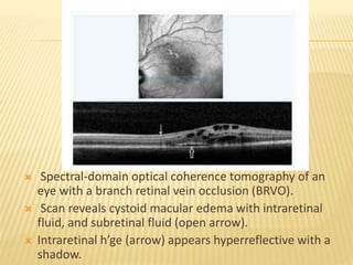  Spectral-domain optical coherence tomography of an
eye with a branch retinal vein occlusion (BRVO).
 Scan reveals cystoid macular edema with intraretinal
fluid, and subretinal fluid (open arrow).
 Intraretinal h’ge (arrow) appears hyperreflective with a
shadow.
 