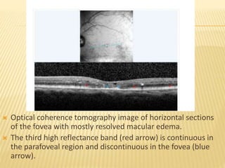  Optical coherence tomography image of horizontal sections
of the fovea with mostly resolved macular edema.
 The third high reflectance band (red arrow) is continuous in
the parafoveal region and discontinuous in the fovea (blue
arrow).
 