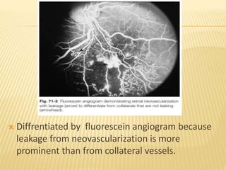  Diffrentiated by fluorescein angiogram because
leakage from neovascularization is more
prominent than from collateral vessels.
 