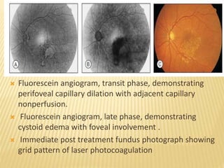  Fluorescein angiogram, transit phase, demonstrating
perifoveal capillary dilation with adjacent capillary
nonperfusion.
 Fluorescein angiogram, late phase, demonstrating
cystoid edema with foveal involvement .
 Immediate post treatment fundus photograph showing
grid pattern of laser photocoagulation
 