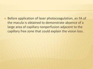  Before application of laser photocoagulation, an FA of
the macula is obtained to demonstrate absence of a
large area of capillary nonperfusion adjacent to the
capillary free zone that could explain the vision loss.
 