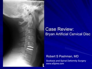 Case Review:
Bryan Artificial Cervical Disc




Robert S Pashman, MD
Scoliosis and Spinal Deformity Surgery
www.eSpine.com
 