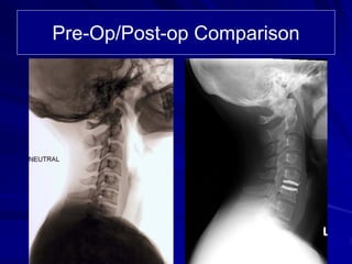 Case Review #9: 40 year old female treated with a Bryan Cervical Disc | PDF
