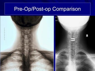 Case Review #9: 40 year old female treated with a Bryan Cervical Disc | PDF