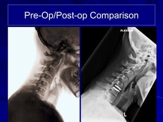 Case Review #9: 40 year old female treated with a Bryan Cervical Disc | PDF