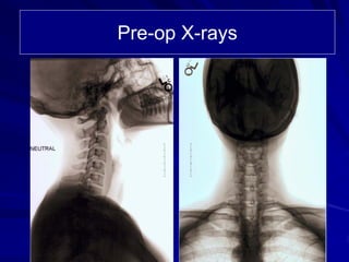 Case Review #9: 40 year old female treated with a Bryan Cervical Disc | PDF