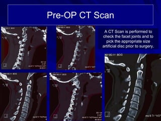 Case Review #9: 40 year old female treated with a Bryan Cervical Disc | PDF