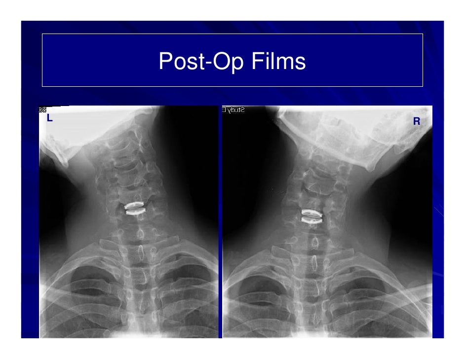 bryan cervical disc prothesis Complications of cervical disc arthroplasty for a cervical disc prothesis 12 in as and transient arm pain after bryan cervical disc replacement despite . bryan cervical disc prothesis Complications of cervical disc arthroplasty for a cervical disc prothesis 12 in as and transient arm pain after bryan cervical disc replacement despite .