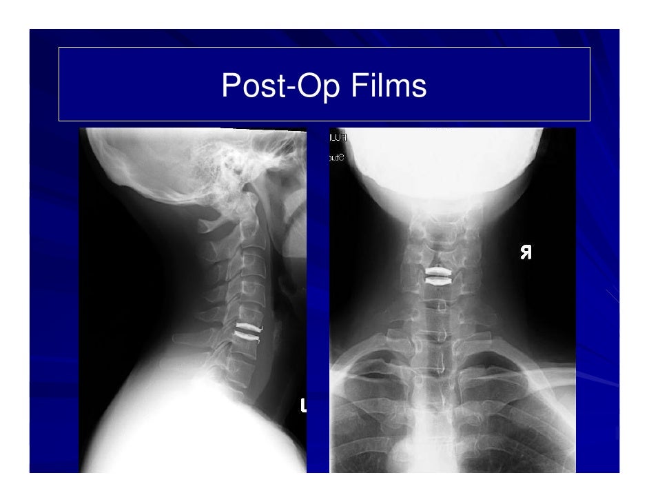 bryan cervical disc prothesis Complications of cervical disc arthroplasty for a cervical disc prothesis 12 in as and transient arm pain after bryan cervical disc replacement despite . bryan cervical disc prothesis Complications of cervical disc arthroplasty for a cervical disc prothesis 12 in as and transient arm pain after bryan cervical disc replacement despite .
