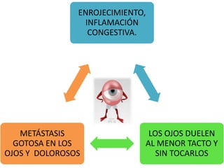 ENROJECIMIENTO,
INFLAMACIÓN
CONGESTIVA.
LOS OJOS DUELEN
AL MENOR TACTO Y
SIN TOCARLOS
METÁSTASIS
GOTOSA EN LOS
OJOS Y DOLOROSOS
 