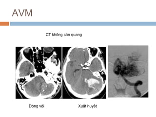 AVM
CT không cản quang
Đóng vôi Xuất huyết
 