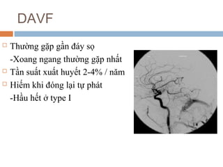DAVF
 Thường gặp gần đáy sọ
-Xoang ngang thường gặp nhất
 Tần suất xuất huyết 2-4% / năm
 Hiếm khi đóng lại tự phát
-Hầu hết ở type I
 