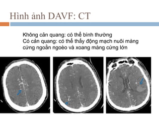 Hình ảnh DAVF: CT
Không cản quang: có thể bình thường
Có cản quang: có thể thấy động mạch nuôi màng
cứng ngoằn ngoèo và xoang màng cứng lớn
 