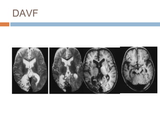 DAVF
 