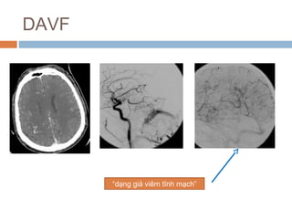 DAVF
“dạng giả viêm tĩnh mạch”
 