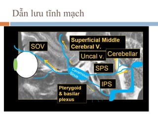 Dẫn lưu tĩnh mạch
 