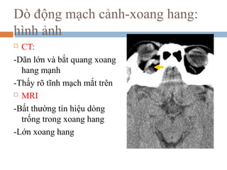 Dò động mạch cảnh-xoang hang:
hình ảnh
 CT:
-Dãn lớn và bắt quang xoang
hang mạnh
-Thấy rõ tĩnh mạch mắt trên
 MRI
-Bất thường tín hiệu dòng
trống trong xoang hang
-Lớn xoang hang
 