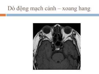 Dò động mạch cảnh – xoang hang
 