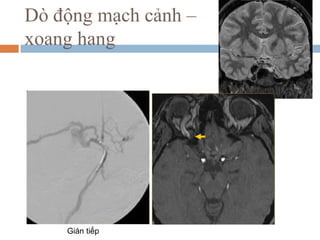 Dò động mạch cảnh –
xoang hang
Gián tiếp
 