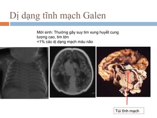 Dị dạng tĩnh mạch Galen
Mới sinh: Thường gây suy tim xung huyết cung
lượng cao, tim lớn
<1% các dị dạng mạch máu não
Túi tĩnh mạch
 