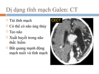  Túi tĩnh mạch
 Có thể có não úng thủy
 Teo não
 Xuất huyết trong não
thất: hiếm
 Bắt quang mạnh động
mạch nuôi và tĩnh mạch
Dị dạng tĩnh mạch Galen: CT
 