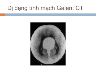 Dị dạng tĩnh mạch Galen: CT
 