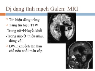  Tín hiệu dòng trống
 Tăng tín hiệu T1W
-Trong túiHuyết khối
-Trong não thiếu máu,
đóng vôi
 DWI: khuếch tán hạn
chế nếu nhồi máu cấp
Dị dạng tĩnh mạch Galen: MRI
 