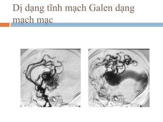 Dị dạng tĩnh mạch Galen dạng
mạch mạc
 