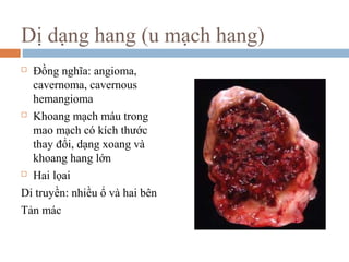 Dị dạng hang (u mạch hang)
 Đồng nghĩa: angioma,
cavernoma, cavernous
hemangioma
 Khoang mạch máu trong
mao mạch có kích thước
thay đổi, dạng xoang và
khoang hang lớn
 Hai lọai
Di truyền: nhiều ổ và hai bên
Tản mác
 