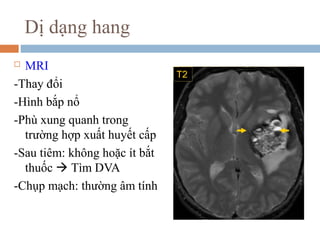 Dị dạng hang
 MRI
-Thay đổi
-Hình bắp nổ
-Phù xung quanh trong
trường hợp xuất huyết cấp
-Sau tiêm: không hoặc ít bắt
thuốc  Tìm DVA
-Chụp mạch: thường âm tính
 