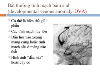 Bất thường tĩnh mạch bẩm sinh
(developmental venous anomaly-DVA)
 Có thể là biến thể giải
phẫu
 Các tĩnh mạch tủy lớn
 Dẫn lưu vào xoang
màng cứng hoặc tĩnh
mạch sâu ở màng não
thất
 Hình ảnh “dầu sứa”
hoặc cây cọ
 