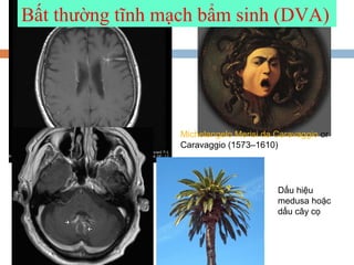 Michelangelo Merisi da Caravaggio or
Caravaggio (1573–1610)
Bất thường tĩnh mạch bẩm sinh (DVA)
Dấu hiệu
medusa hoặc
dấu cây cọ
 