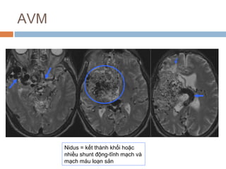 AVM
Nidus = kết thành khối hoặc
nhiều shunt động-tĩnh mạch và
mạch máu loạn sản
 