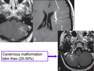 Cavernous malformation
kèm theo (25-30%)
 