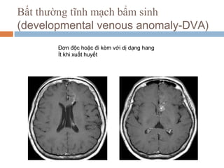 Đơn độc hoặc đi kèm với dị dạng hang
Ít khi xuất huyết
Bất thường tĩnh mạch bẩm sinh
(developmental venous anomaly-DVA)
 