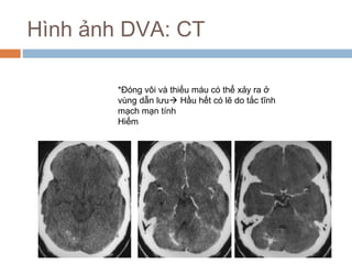 Hình ảnh DVA: CT
*Đóng vôi và thiếu máu có thể xảy ra ở
vùng dẫn lưu Hầu hết có lẽ do tắc tĩnh
mạch mạn tính
Hiếm
 