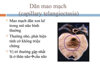 Dãn mao mạch
(capillary telangiectasia)
 Mao mạch dãn xen kẽ
trong mô não bình
thường
 Thường nhỏ, phát hiện
tình cờ không triệu
chứng
 Vị trí thường gặp nhất
là ở thân nãocầu não
 