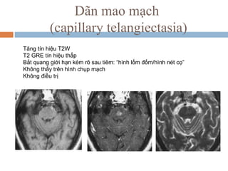 Dãn mao mạch
(capillary telangiectasia)
Tăng tín hiệu T2W
T2 GRE tín hiệu thấp
Bắt quang giới hạn kém rõ sau tiêm: “hình lốm đốm/hình nét cọ”
Không thấy trên hình chụp mạch
Không điều trị
 