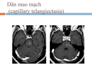 Dãn mao mạch
(capillary telangiectasia)
 