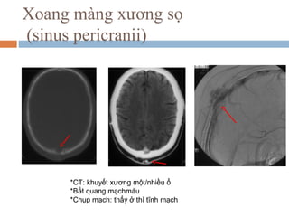 Xoang màng xương sọ
(sinus pericranii)
*CT: khuyết xương một/nhiều ổ
*Bắt quang mạchmáu
*Chụp mạch: thấy ở thì tĩnh mạch
 