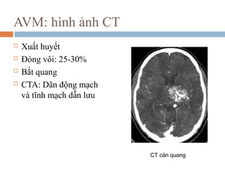 AVM: hình ảnh CT
 Xuất huyết
 Đóng vôi: 25-30%
 Bắt quang
 CTA: Dãn động mạch
và tĩnh mạch dẫn lưu
CT cản quang
 