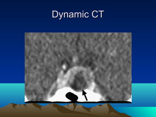 Bs.tuong mri tuyen yen | PPT