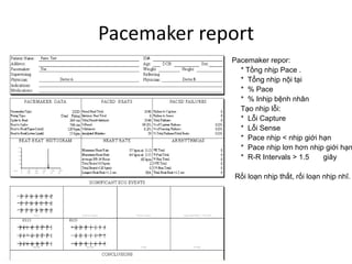 Pacemaker Reporting Đọc Holter ECG 24h | PDF