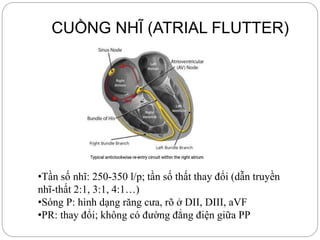 CUỒNG NHĨ (ATRIAL FLUTTER)
•Tần số nhĩ: 250-350 l/p; tần số thất thay đổi (dẫn truyền
nhĩ-thất 2:1, 3:1, 4:1…)
•Sóng P: hình dạng răng cưa, rõ ở DII, DIII, aVF
•PR: thay đổi; không có đường đẳng điện giữa PP
 