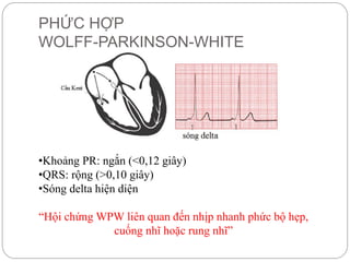 PHỨC HỢP
WOLFF-PARKINSON-WHITE
•Khoảng PR: ngắn (<0,12 giây)
•QRS: rộng (>0,10 giây)
•Sóng delta hiện diện
“Hội chứng WPW liên quan đến nhịp nhanh phức bộ hẹp,
cuống nhĩ hoặc rung nhĩ”
 