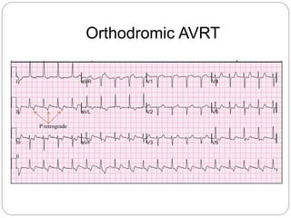 Orthodromic AVRT
P retrograde
 