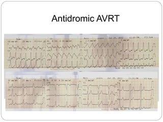 Antidromic AVRT
 