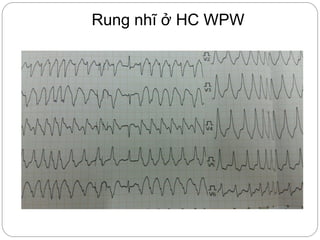 Rung nhĩ ở HC WPW
 