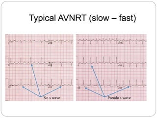 Typical AVNRT (slow – fast)
Pseudo s waveNo s wave
 