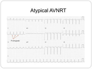 Atypical AVNRT
P retrograde
 